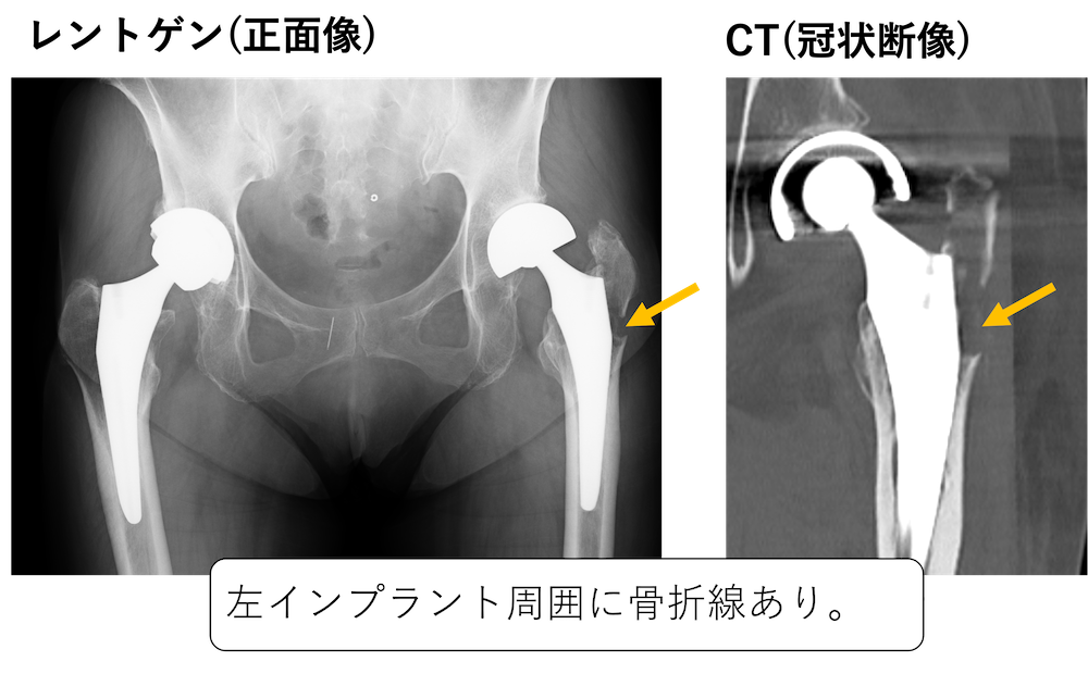 大腿骨ステム周囲骨折のCT画像所見のポイント